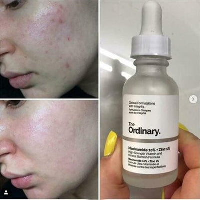 The Ordinary Niacinamide 10% + Zinc 1% – 30ml (100%) Orignal | Free Shipping | Cash on Delivery